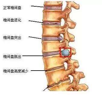 腰椎间盘突出症-玄鹿中频微电脑治疗仪