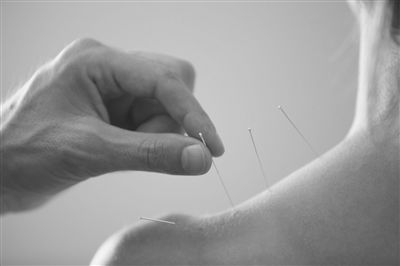针灸疗法治疗颈肩腰腿痛