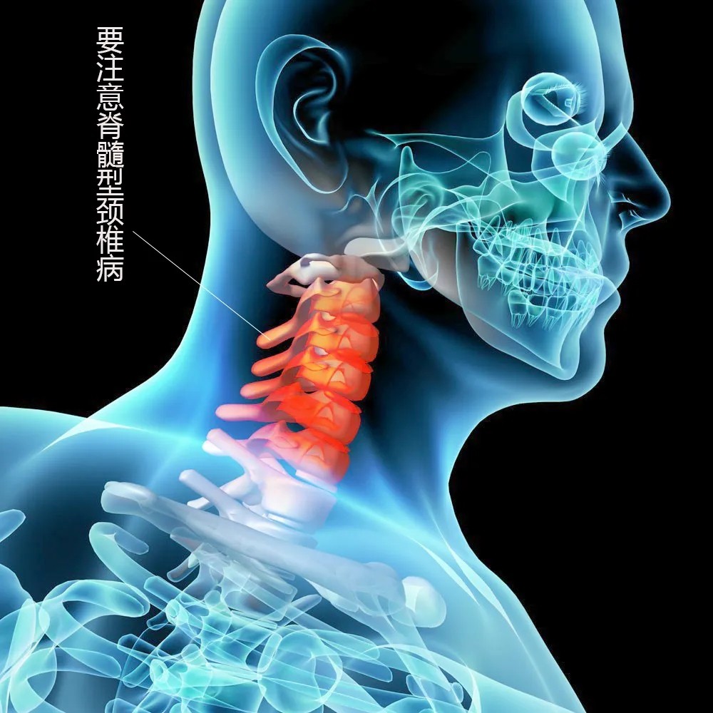 脊髓型颈椎病.webp.jpg